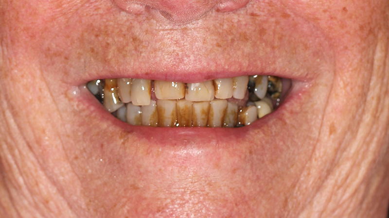 Smile Gallery - Next Step Smiles - Jacksonville